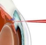 chirurgia, chirurgia occhio, chirurgia glaucoma